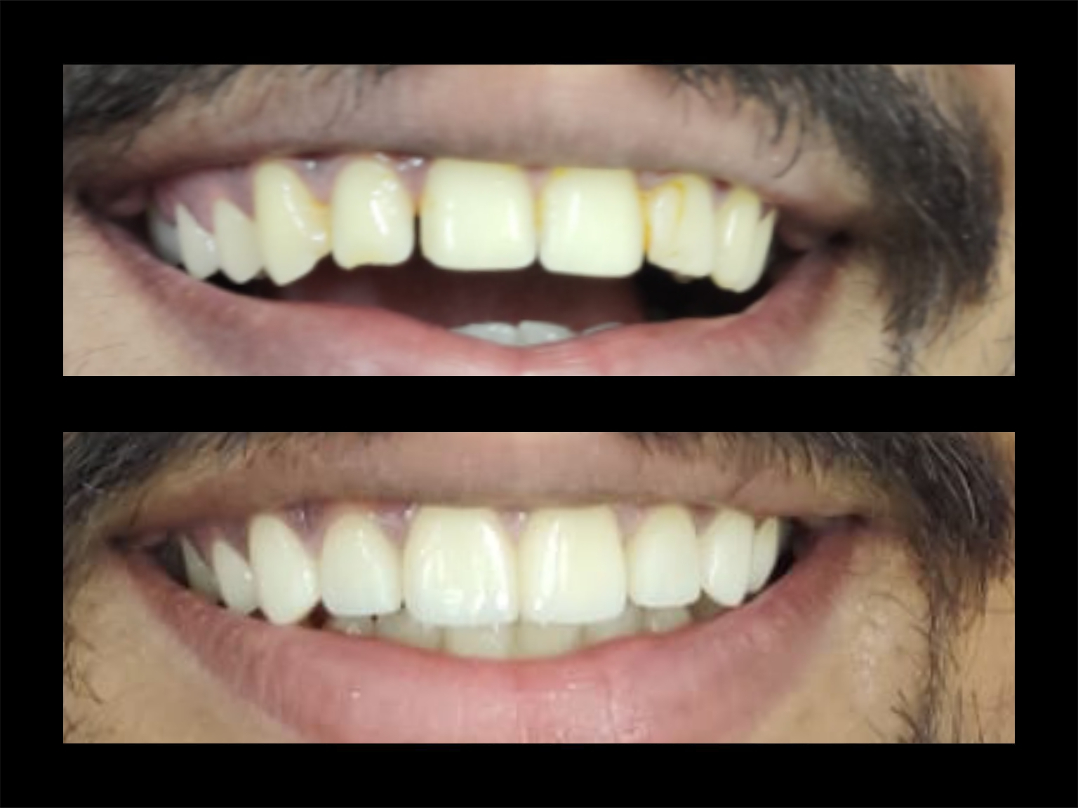 Smile Transformation 3